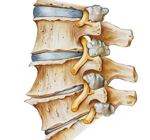 Pinching of the nerve in the spine