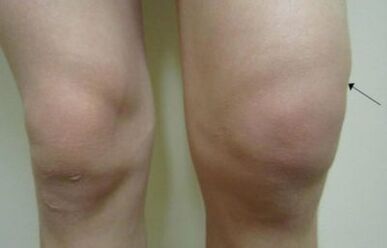 Clinical manifestations of arthrosis of the knee joint