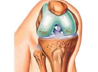 The main causes of knee arthrosis
