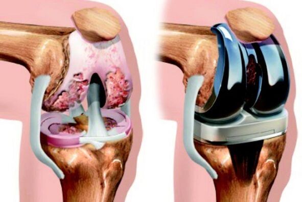 before and after endoprosthetics of the knee joint with arthrosis