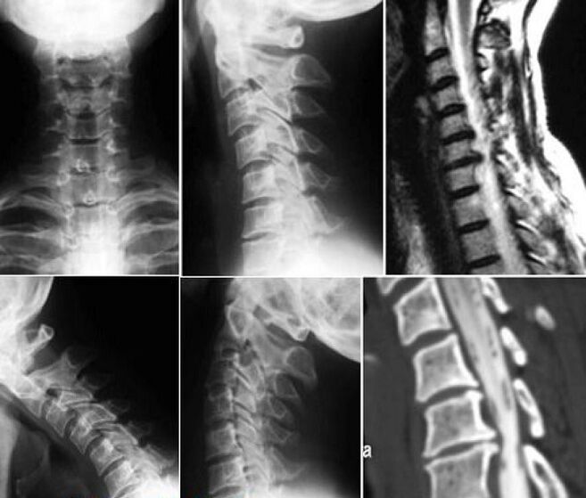 X-ray of the cervical spine for the diagnosis of osteochondrosis