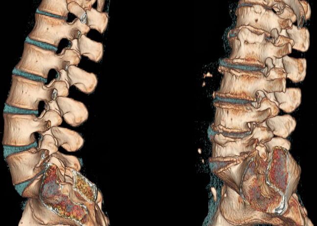 Osteochondrosis of the spine on a CT scan