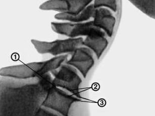 Osteophytes in the cervical spine with osteochondrosis
